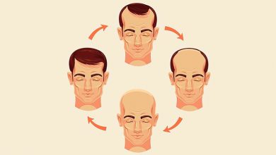 Hair Loss